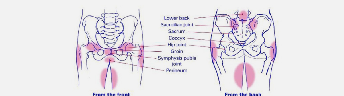 Pubic Symphysis Pain, Pubic Related Groin Pain and Pelvic Girdle Pain